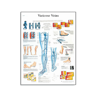 Poster laminato sulle vene varicose