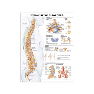 Poster sulle malattie della colonna vertebrale in pellicola di plastica PET lucida (inglese) (Patologie della colonna vertebrale
