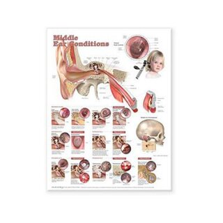 Poster laminato sulle malattie dell'orecchio medio in inglese